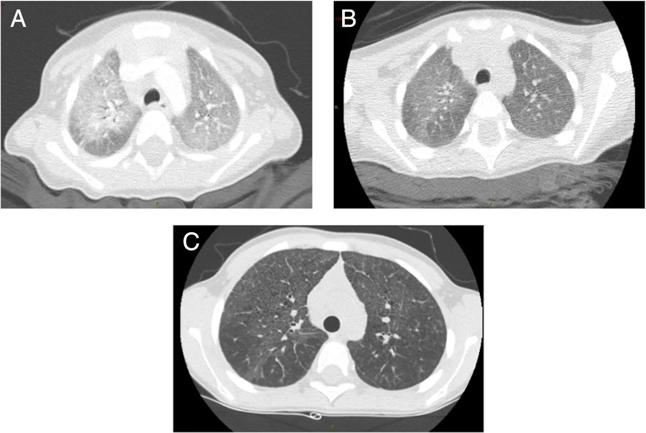 CT scan image of lungs showing interstitial lung disease patterns