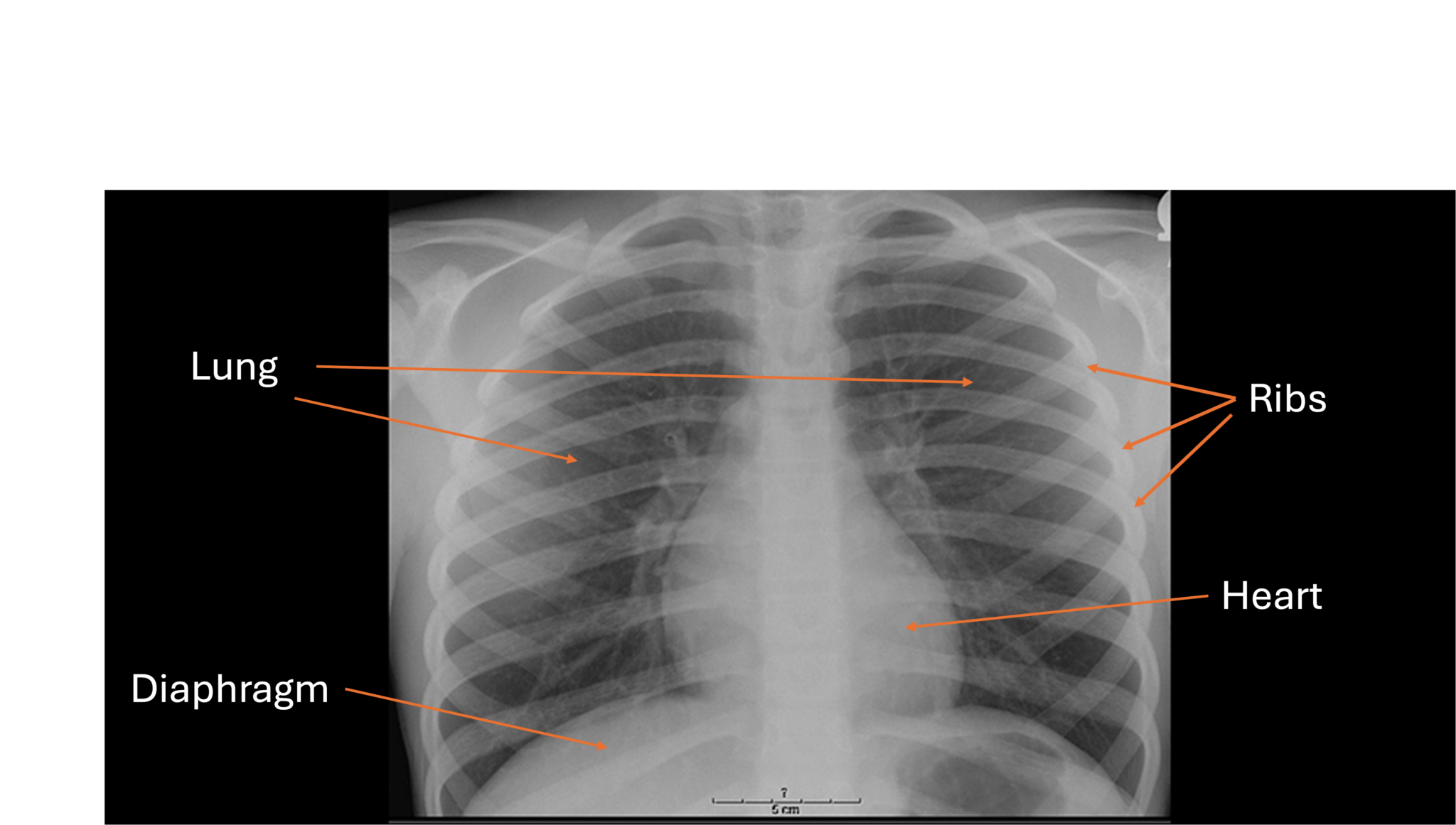 Chest X Rays - chILD Foundation